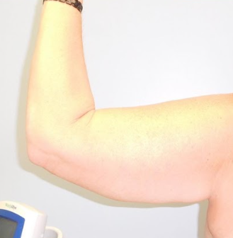 Advanced Arm Lift Surgery & Comprehensive Care
