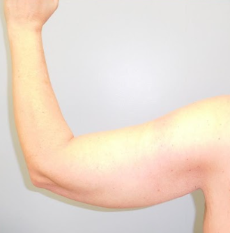 Advanced Arm Lift Surgery & Comprehensive Care