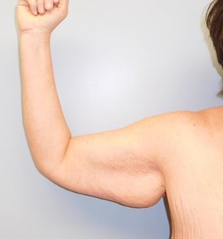 Advanced Arm Lift Surgery & Comprehensive Care