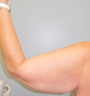 Advanced Arm Lift Surgery & Comprehensive Care