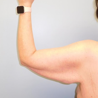 Advanced Arm Lift Surgery & Comprehensive Care