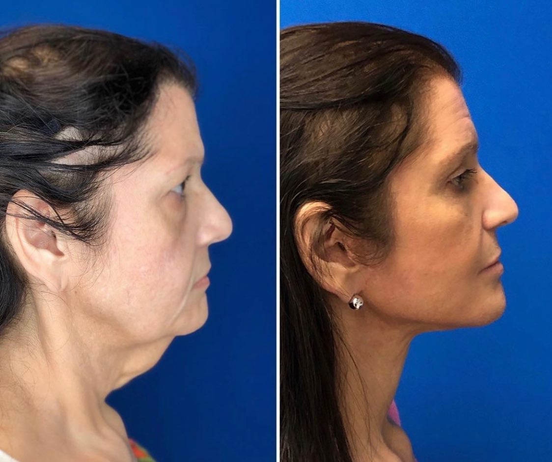 Neck Lift