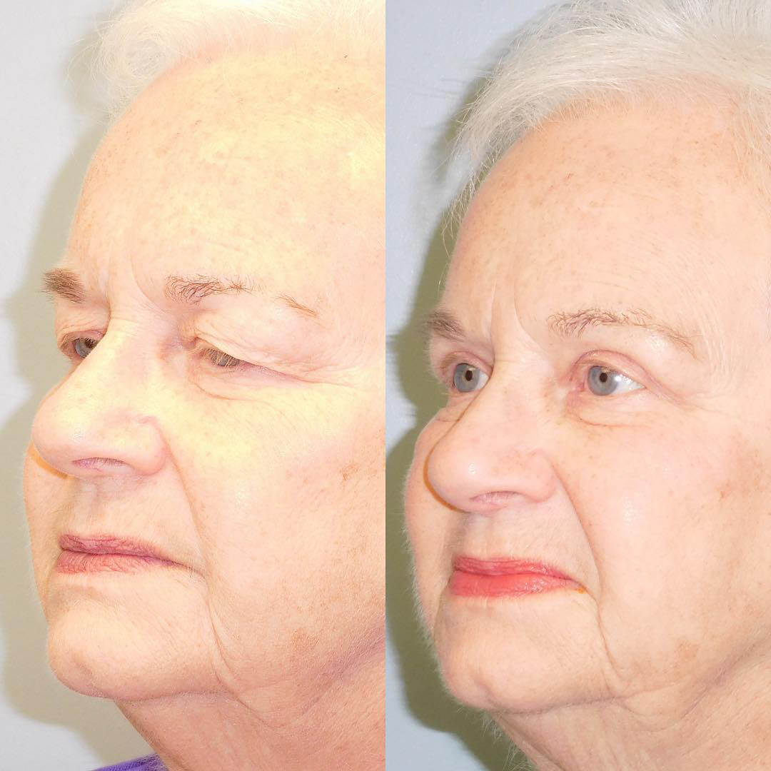 Blepharoplasty
