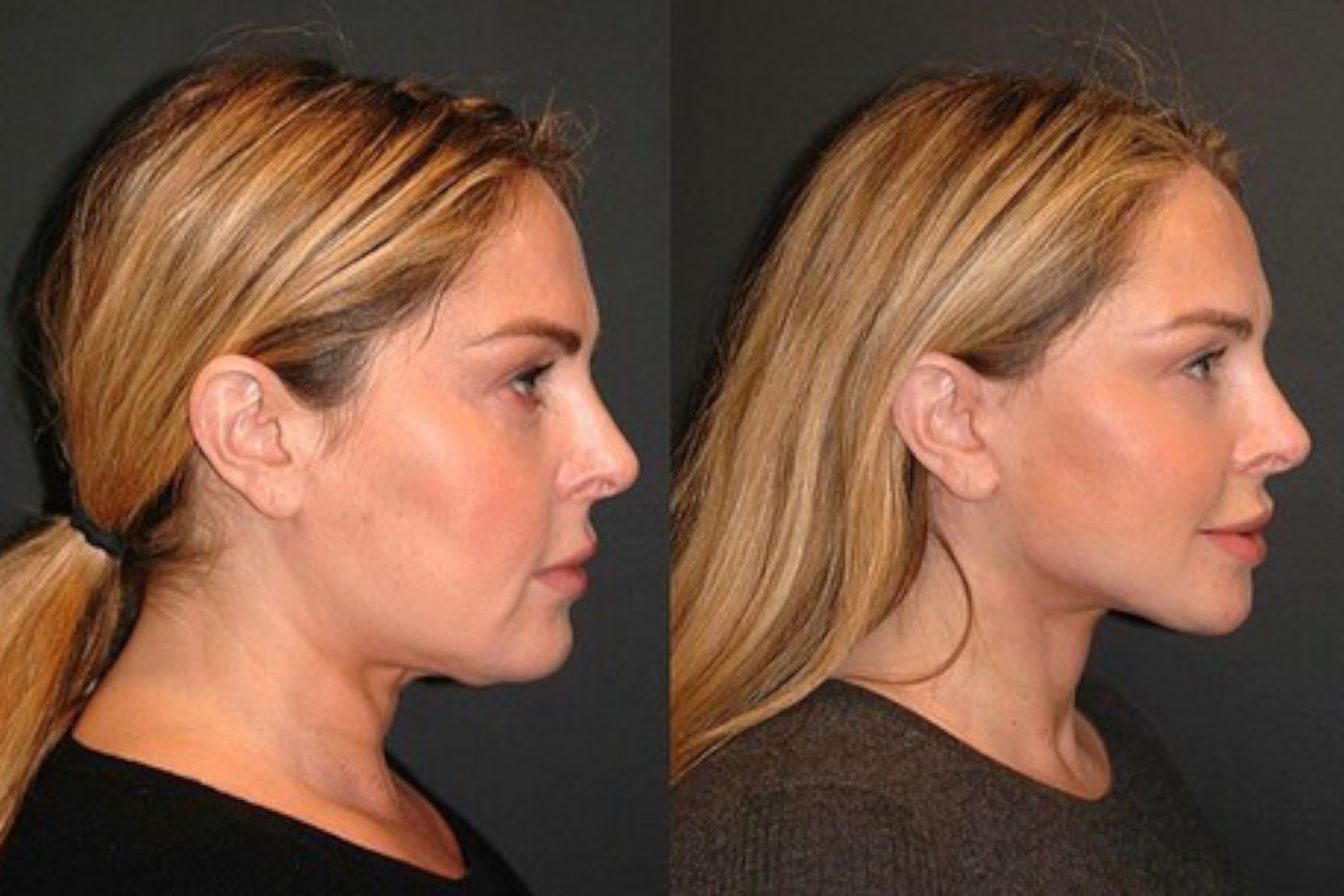 Facelift
