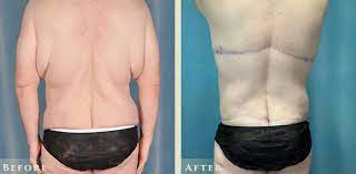 Abdominoplasty