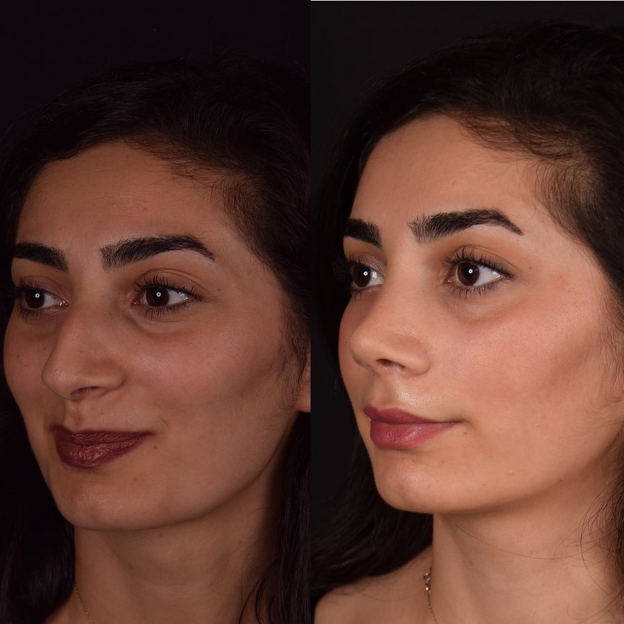 Rhinoplasty