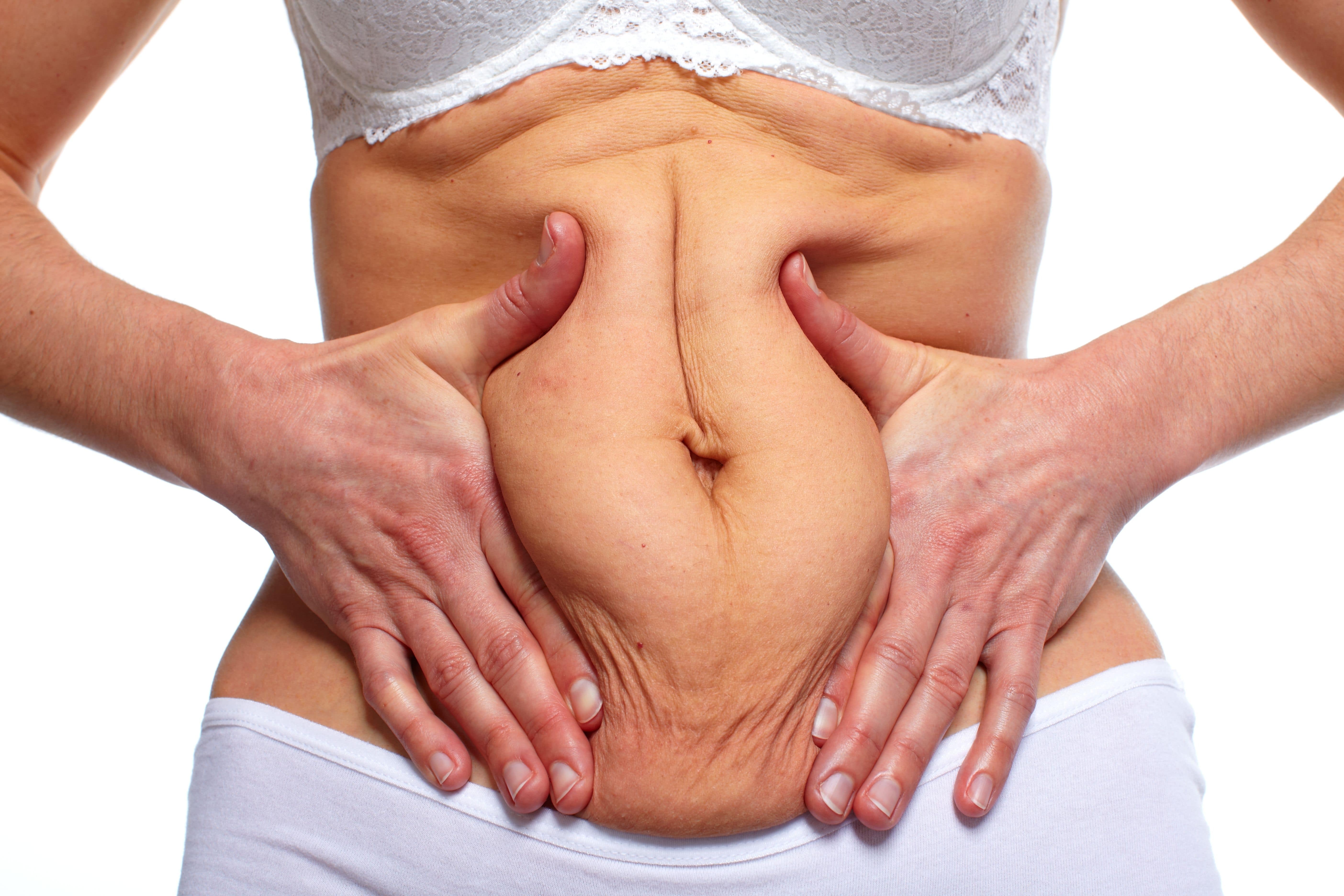 Tummy tuck
